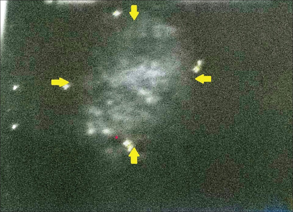 29-year-old female with swelling on the right side of her tongue diagnosed as lymphangioma circumscriptum. Soft-tissue ultrasonograph of the tongue demonstrates a well-defined heterogeneous soft tissue mass of 2.3 cm × 3.3 cm × 2.4 cm (yellow arrows) seen on the right half of the tongue suggestive of a soft tissue tumor.