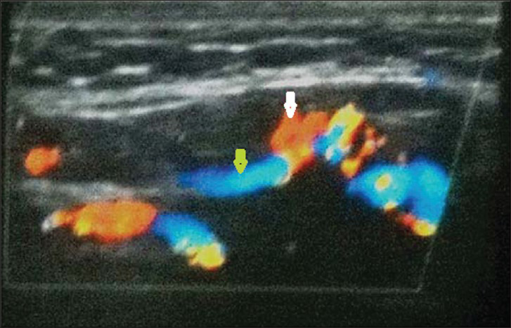 29-year-old female with swelling on the right side of her tongue diagnosed as lymphangioma circumscriptum. Color Doppler imaging in longitudinal section through the right side of the tongue and sub mental region shows heterogeneous mass along with dilated arteries (white arrow) and veins (yellow arrow) suggestive of a vascular malformation.