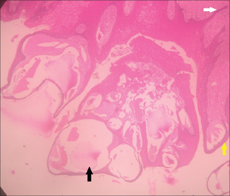 29-year-old female with swelling on the right side of her tongue diagnosed as lymphangioma circumscriptum. Hematoxylin and eosin stained soft-tissue section under ×40 magnification shows elongated rete ridges (white arrow), papillamatosis (yellow arrow), and cavernous spaces filled with lymph represented as eosinophilic stain (black arrow) suggestive of lymphangioma circumscriptum.