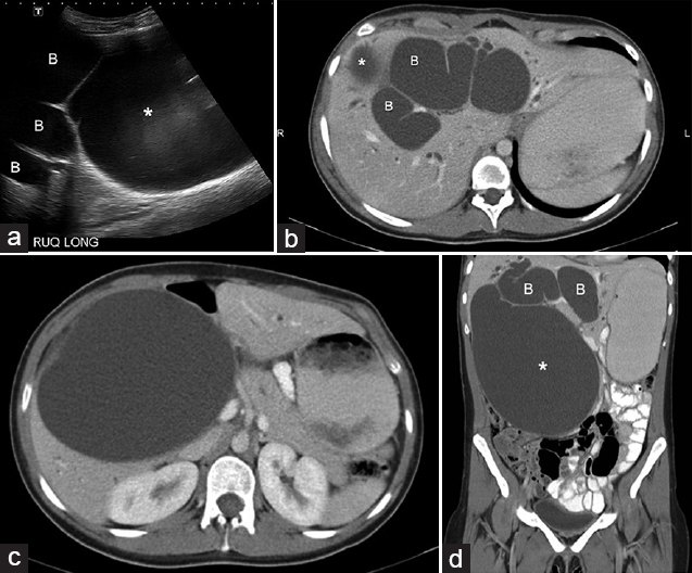 19-year-old female with intermittent abdominal pain and jaundice diagnosed with Type 1A giant choledochal cyst. (a) Ultrasound scan axial view shows a large cystic mass (*) and dilated bile ducts (B). The mass was very large and the relationship of the biliary tree to the mass was not clear on ultrasound. (b) Computed tomography (CT) scan, axial view of portal venous phase demonstrates dilated intrahepatic ducts (B). Superior portion of the cystic mass is visualized (*). (c) Computed tomography scan axial view at a lower level than 1b shows a large cystic mass (*) at the porta hepatis. (d) Coronal reformatted computed tomography image delineates a huge cystic mass in right upper quadrant (*). Dilated bile ducts are visualized (B).