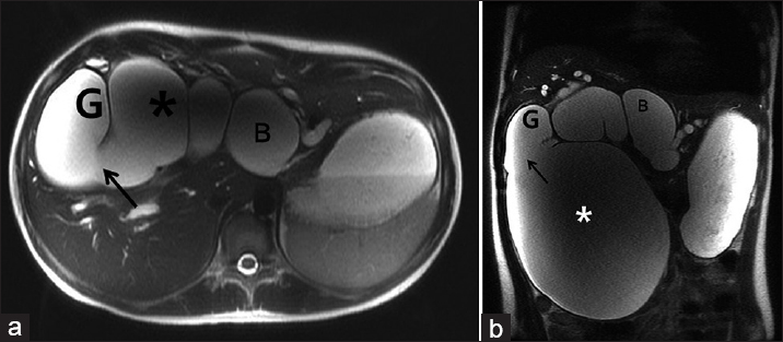 19-year-old female with intermittent abdominal pain and jaundice diagnosed with Type 1A giant choledochal cyst. a) Axial and b) coronal heavily T2-weighted images show a large cystic mass (*), gallbladder (G) and intrahepatic ducts (B). Communication of the gallbladder and cystic mass is visualized (arrow).