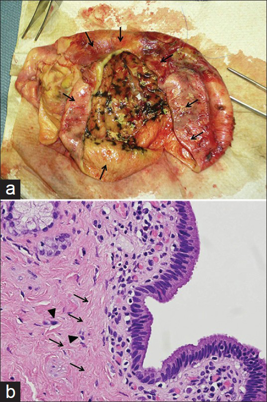 19-year-old female with intermittent abdominal pain and jaundice diagnosed with Type 1A giant choledochal cyst. a) The gross specimen obtained after excision of the cystic mass shows a massive, thick walled cystic lesion (arrows) measuring over 20 cm in maximum dimension arising from the left hepatic duct and confirms the diagnosis of a giant choledochal cyst. (b) H and E stained tissue (×400), shows the dilated bile duct with columnar epithelial lining, and dense fibrous wall; scattered smooth muscle and elastic fibers are present (arrows); mild infiltration of chronic inflammatory cells are also seen (arrowheads). There is no evidence of dysplasia or malignancy
