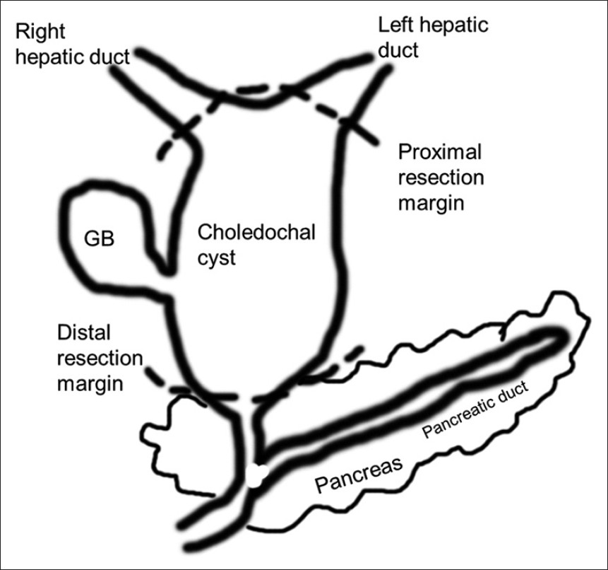 Schematic diagram shows the location of the choledochal cyst and resection margin (dotted lines).