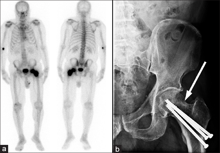 70-year-old male with mild left hip pain and elevated alkaline phosphatase diagnosed with radiogenic osteosarcoma. (a) The planar whole body images of the technetium-99m methylene diphosphonate bone scan demonstrates intense diffuse uptake extending from the left femoral head to the proximal shaft of the femur (double ended arrow). (b) The plain film of the left hip depicts three previously unreported fixation screws surrounded by osteopenic lesions (arrow) in the femoral neck and head.