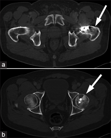 70-year-old male with mild left hip pain and elevated alkaline phosphatase diagnosed with radiogenic osteosarcoma. (a and b) Computed tomography of the pelvis reveal mixed lytic/sclerotic lesions (arrows) within the native bone, although evaluation of the left hip was limited due to streak artifact as seen on the two axial slices in Figure 1.