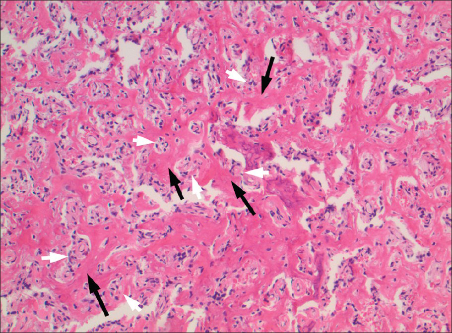 70-year-old male with mild left hip pain and elevated alkaline phosphatase diagnosed with radiogenic osteosarcoma. Histologic examination of the curettage (using Hematoxylin and Eosin stain, ×10) reveals sarcomatous, spindle shaped cells (white arrows) with adjacent tumor osteoid production (black arrows); represented by eosinophilic, amorphous, fibrillary deposits (white arrows) between individual or small aggregates of tumor cells (black arrows).