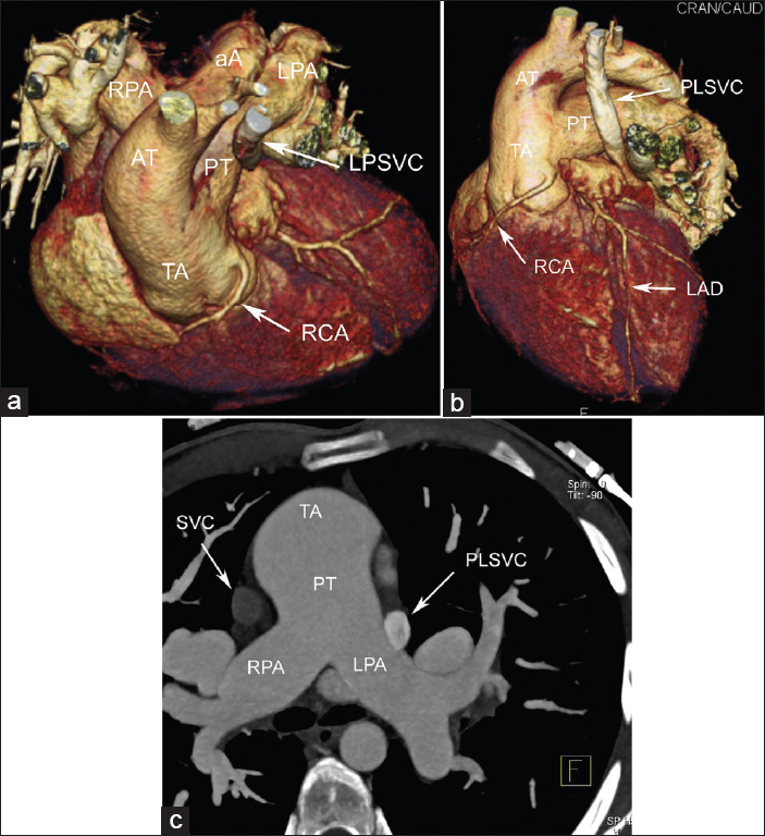 24-year-old male patient with unrepaired truncus arteriosus (TA) admitted to adult congenital cardiology clinic for surgical operation. The three-dimensional volume-rendered cardiac computed tomography angiogram a) Oblique superior-inferior, b) Anterior-left lateral and c) axial maximum intensity projection views show an anatomical pattern consistent with TA Type 1A with persistent left superior vena cava. The right coronary artery branches from the non-coronary sinus at the left side of the truncus.