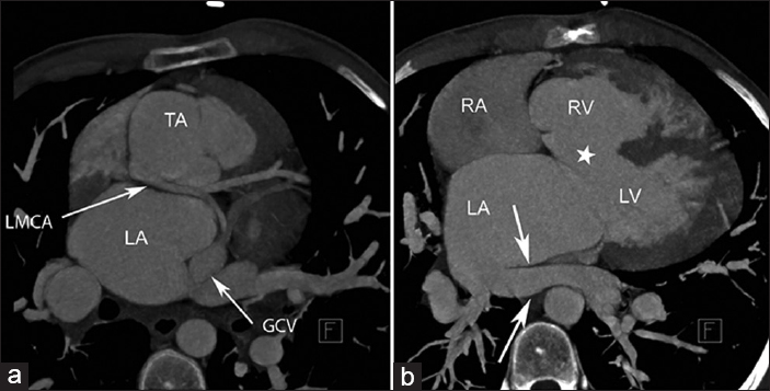 24-year-old male patient with unrepaired truncus arteriosus admitted to adult congenital cardiology clinic for surgical operation. a) Axial maximum intensity projection (MIP) image shows a large subarterial ventricular septal defect (white star) and the left inferior pulmonary vein (arrows) drained into the right side of the left atrium. b) Axial (MIP) image demonstrates the left coronary artery orifice with a retro-aortic course was positioned in the right posterior part of the truncus.