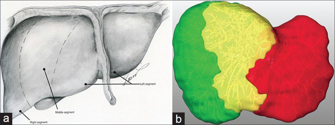 Takasaki's concept of 3 sectors (he calls segments).[2] (a) Original figure, (b) rendering on our liver cast.