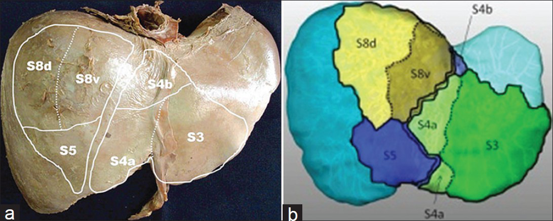 According to Lee et al.,[36] Segment VIII is subdivided into 2 subsegments (d, v) for the sake of illustrating homology with Segment IV (a, b). (a) Original illustration, (b) concept applied to our liver cast.