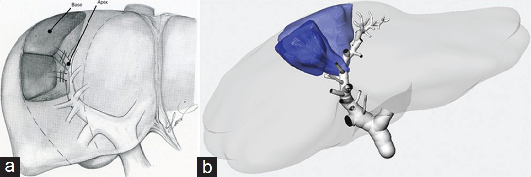 Takasaki implicite subdivided the liver into 18-24 subsegments (he named cone units).[2] (a) Original picture, illustrating two subsegments, taking 3rd order branches of the main portal branch to the right anterior sector as an example, (b) corresponding reconstruction on the corrosion cast.