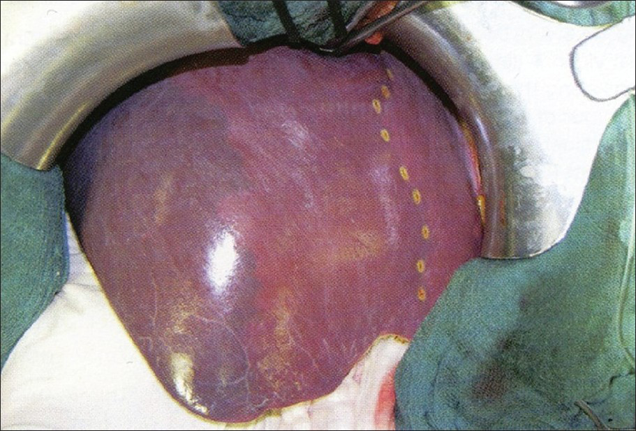 Intraoperative situs documenting that the boundaries of the vascular territories are not always simple straight lines (corresponding to orthogonal flat planes), but may display wavy outlines. (Courtesy Prof. P. Majno, Department of Visceral Surgery, Geneva University Hospitals, Switzerland).
