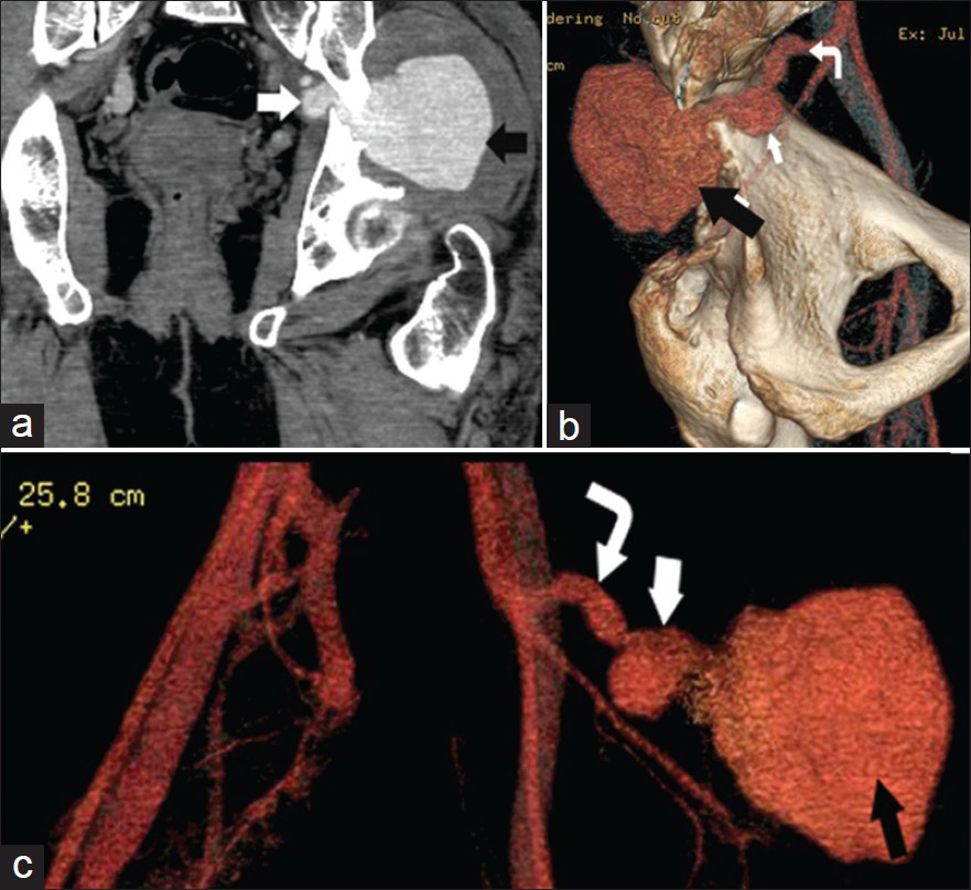 38-year-old female with left gluteal swelling diagnosed with superior gluteal artery aneurysm. Contrast enhanced CT pelvis shows the aneurysm with a large extrapelvic (black arrow), a small intrapelvic components (white arrow) and Left superior gluteal artery (curved arrow). (a) Coronal reformat shows aneurysm extension through the greater sciatic notch. (b) and (c) Volume rendered images, internal and anterior views of the pelvis, demonstrate the two components of aneurysm and its origin from the superior gluteal artery.