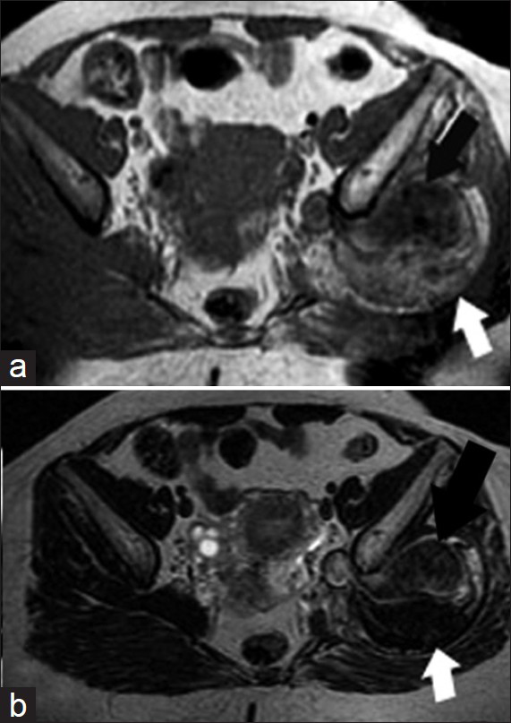 38-year-old female with left gluteal swelling diagnosed with superior gluteal artery aneurysm. MRI pelvis axial plain images: (a) T1-weighted (b) T2-weighted images reveal the superior gluteal aneurysm has a signal void lumen (black arrow) and surrounding heterogeneous thrombus with predominantly high T1 and low T2 signal intensities (white arrow).