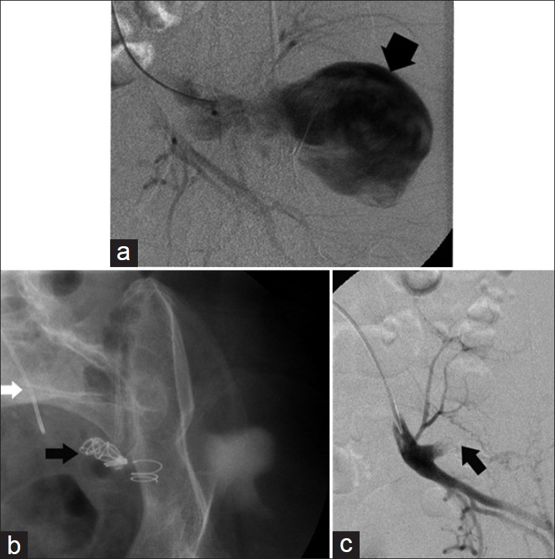 38-year-old female with left gluteal swelling diagnosed with superior gluteal artery aneurysm. (a and b) DSA selective catheterization of internal iliac and superior gluteal artery demonstrate the pseudoaneurysm (broad black arrow). (c) DSA following successful embolization shows coils occluding aneurysm neck (black narrow arrows) with complete cessation of blood flow inside the aneurysm.