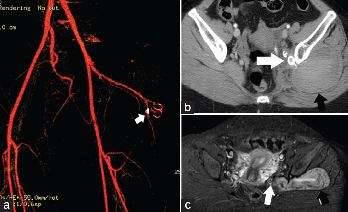 38-year-old female with left gluteal swelling diagnosed with superior gluteal artery aneurysm. Follow-up studies shows exclusion of the aneurysm: (a and b) CT angiography one week postembolization, axial cut and volume rendered reformat (c) MRI axial STIR few months postembolization show aneurysm clips (white arrows), and residual hematoma (black arrows).