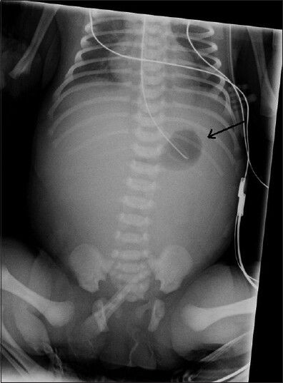 Female baby at 2 h after birth with distended abdomen diagnosed with intrauterine volvulus of terminal ileum without malrotation. X-ray of abdomen shows distended and gasless abdomen except a small amount of air in the stomach (black arrow).