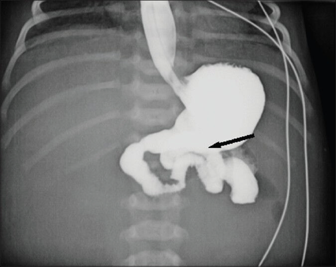 Female baby at 2 h after birth with distended abdomen diagnosed with intrauterine volvulus of terminal ileum without malrotation. Barium study shows normal location of Trieitz ligament (black arrow).