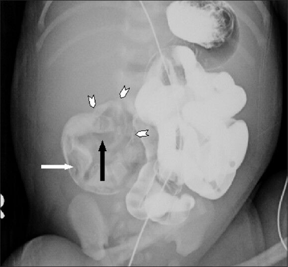 Female baby at 13 h after birth with distended abdomen diagnosed with intrauterine volvulus of terminal ileum without malrotation. At 13 h, the barium study shows stopage of barium with a beak-like shape of the pre-obstructed bowel (black arrow) with filling defect(white arrow) and a structure containing air around the end loop (arrowheads)