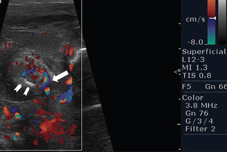 Female baby at 13 h after birth with distended abdomen diagnosed with intrauterine volvulus of terminal ileum without malrotation. Ultrasonographic examination of the abdomen shows a target lesion consistent with two loops of bowel, pneumatosis of the bowel wall (arrowheads) and twisting of vessels (white arrow).