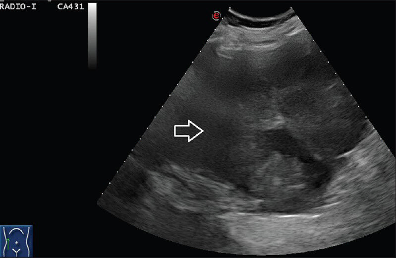 75 year-old female with a large abdominal mass diagnosed with primary renal fibrosarcoma. Gray-scale ultrasound scan using subcostal approach in coronal plane with convex (5-7 MHz) probe in right lumbar region shows an ill-defined heterogenous mixed echogenicity mass which cannot be separately made out from liver and kidney.