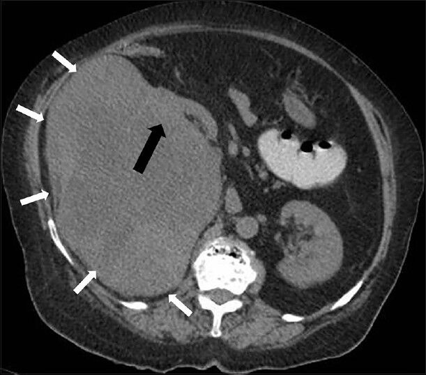 75-year-old female with a large abdominal mass diagnosed with primary renal fibrosarcoma. Non-enhanced computed tomography abdomen, Axial section shows a well-defined lobulated heterogeneous soft tissue attenuation lesion in the right renal bed (small white arrows) with loss of intervening fat plane (black arrow).