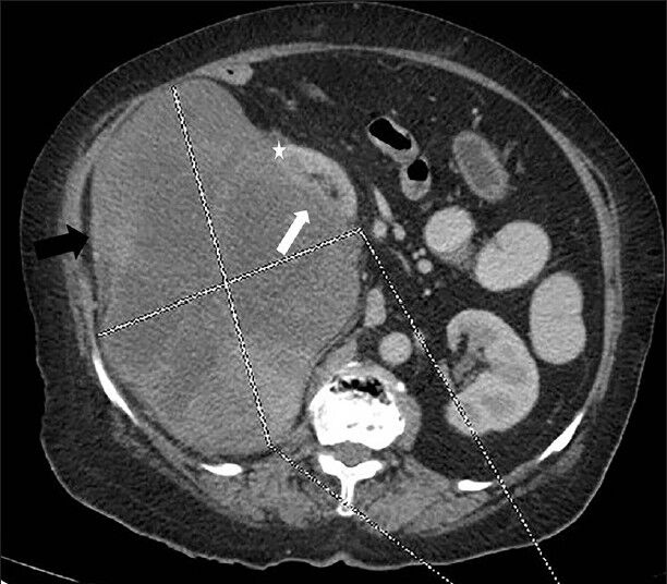 75-year-old female with a large abdominal mass diagnosed with primary renal fibrosarcoma. Contrast-enhanced computed tomography abdomen, Axial section in nephrographic phase shows well-defined exophytic heterogeneously enhancing right renal mass (showed by lines) with internal low attenuation areas (black arrow) causing indentation of the underlying renal cortex (white arrow) and displacing kidney superomedially. No evidence of invasion of underlying kidney is noted (Note the distinct mass lesion; cortex interface) (asterisk).