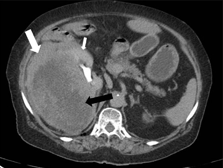 75-year-old female with a large abdominal mass diagnosed with primary renal fibrosarcoma. Contrast-enhanced computed tomography abdomen, Axial section in excretory phase reveals progressively increasing enhancement of renal parenchyma (small white arrow) and lesion (especially peripheral part) (white arrow). Central areas of lesion shows minimal contrast enhancement (black arrow).