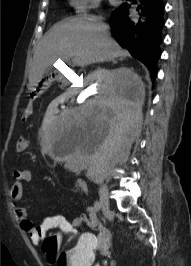75-year-old female with a large abdominal mass diagnosed with primary renal fibrosarcoma. Contrast-enhanced computed tomography abdomen, Sagittal section in excretory phase demonstrates normal contrast excretion (white arrow) from the kidney and no evidence of invasion of pelvicalyceal system. A distinct fat plane is noted between the mass lesion and inferior surface of liver.
