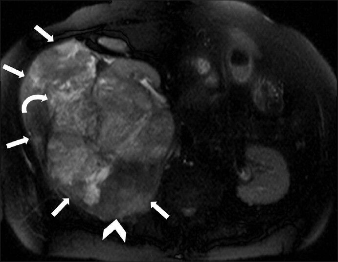 75-year-old female with a large abdominal mass diagnosed with primary renal fibrosarcoma. Non-enhanced magnetic resonance imaging of abdomen, T2-weighted axial section shows a large, well-defined, lobulated mass with extremely heterogeneous signal intensity (white small arrows). The central part appears mildly hyperintense (curved arrow) and peripheral areas show significant hypointensity (arrowhead).
