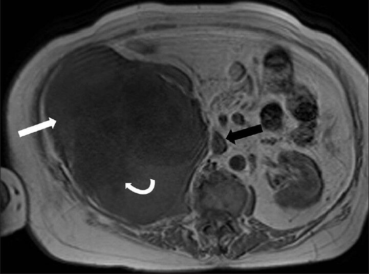 75-year-old female with a large abdominal mass diagnosed with primary renal fibrosarcoma. Non-enhanced magnetic resonance imaging of abdomen, T1-weighted axial section reveals that the mass has low signal-intensity areas (curved white arrow) more toward the center and iso to hypointense areas more in the periphery (white arrow) (intensity similar to skeletal muscle). Note the normal flow related signal void in the inferior vena cava on fast spin echo (FSE) images which suggests absence of intraluminal thrombus (black arrow).