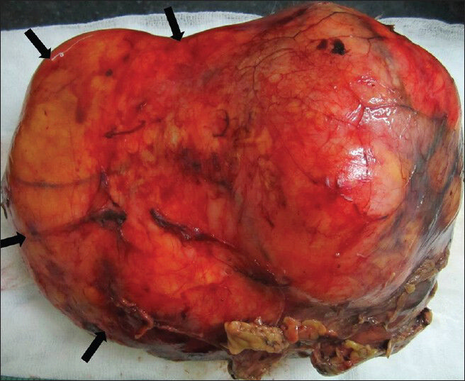 75-year-old female with a large abdominal mass diagnosed with primary renal fibrosarcoma. Postoperative specimen of right renal mass. Gross specimen shows bosselated, smooth-surfaced, encapsulated lesion.