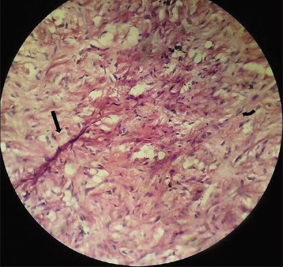 75-year-old female with a large abdominal mass diagnosed with primary renal fibrosarcoma. Photomicrograph of Hematoxylin and Eosin stained (×40) specimen shows elongated spindle cells (black arrow) arranged in whorls with nuclear atypia (curved arrow).