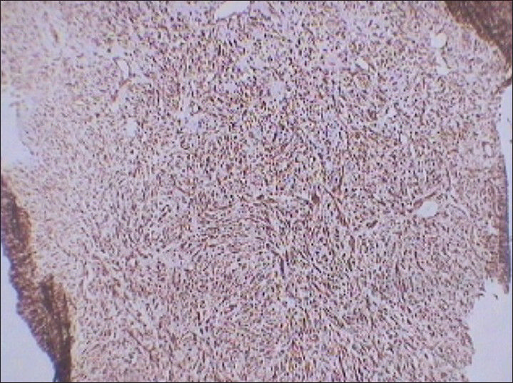 75 year-old female with a large abdominal mass diagnosed with primary renal fibrosarcoma. Photomicrograph (×10) of immunohistochemical staining for Vimentin (generalized soft tissue marker) shows diffuse reactivity.