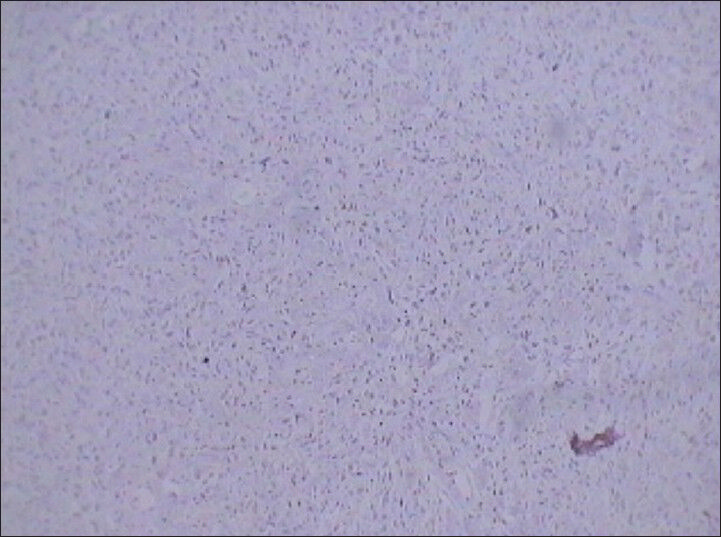 75 year-old female with a large abdominal mass diagnosed with primary renal fibrosarcoma. Photomicrograph (×10) of immunohistochemical staining for Ki-67 (cellular proliferation marker) shows diffuse reactivity. Positive reaction to this marker indicates malignant lesions.