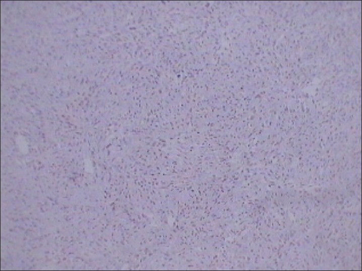 75 year-old female with a large abdominal mass diagnosed with primary renal fibrosarcoma. Photomicrograph (×10) Immunohistochemical staining for CK (Cytokeratin) not showing reactivity for tumor cells.