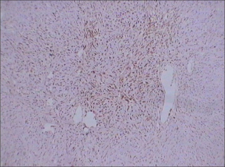 75 year-old female with a large abdominal mass diagnosed with primary renal fibrosarcoma. Photomicrograph (×10) of immunohistochemical staining for S-100 shows positive reaction to the marker indicating tumor cells.