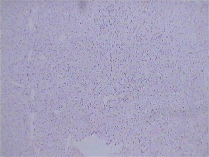 75 year-old female with a large abdominal mass diagnosed with primary renal fibrosarcoma. Photomicrograph (original magnification, ×10;) of immunohistochemical staining for HMB-45 (melanocytic marker) shows no reactivity.