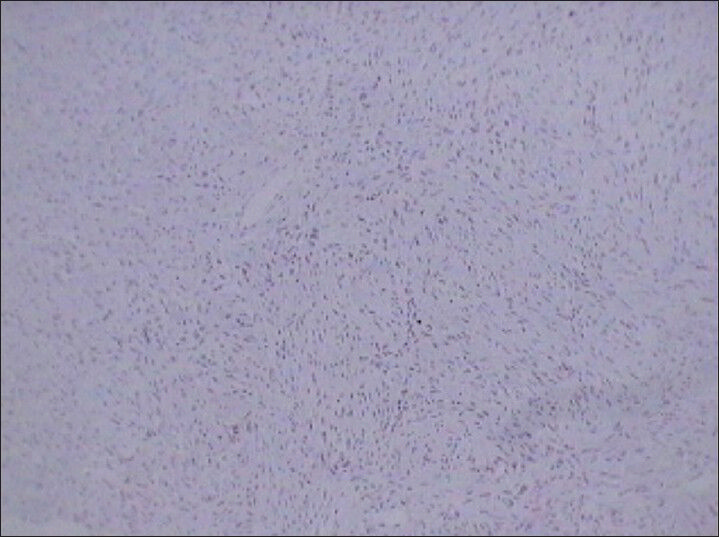 75 year-old female with a large abdominal mass diagnosed with primary renal fibrosarcoma. Photomicrograph (×10) of immunohistochemical staining for Bcl-2 (lymphomatous lineage) shows no reactivity.
