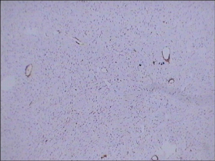 75 year-old female with a large abdominal mass diagnosed with primary renal fibrosarcoma. Photomicrograph (×10); of immunohistochemical staining for SMA-10 (smooth muscle origin) shows no reactivity.