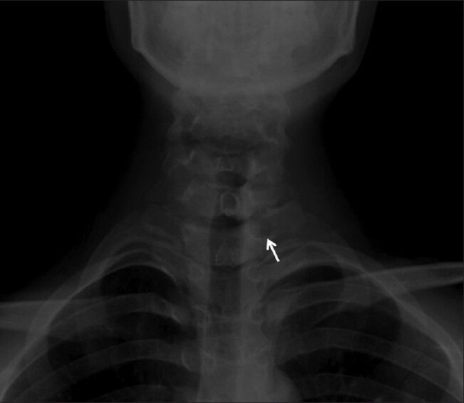 18-year-old male with a 6-month history of pain in left half of the neck, left shoulder and arm, which was more severe at the night, diagnosed with osteoid osteoma. Anteroposterior cervical X-ray shows radiolucent nodular, well-contoured lesion (arrow) having a mild sclerotic rim located in left neural arch on T1 vertebra.