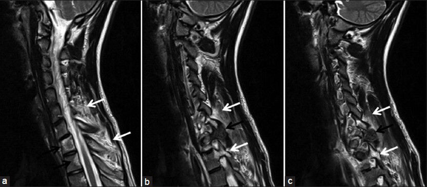 18-year-old male with a 6-month history of pain in left half of the neck, left shoulder and arm, which was more severe at the night, diagnosed with osteoid osteoma. T2-weighted spinal magnetic resonance imaging in sagittal plane (a) shows signals that belong to heterogeneous hyperintense edema in T1 and T2 vertebrae bodies (black arrow) and paravertebral soft tissues (white arrows) and (b and c) show slightly heterogeneous hypointense osteoid osteoma (black arrows) of a 1.5 cm diameter with hypointensities that belong to millimetric calcific matrix in T1 vertebra left lamina-transverse process junction. Edema is present in paravertebral soft tissues and in pedicules adjacent to the lesion (white arrows).