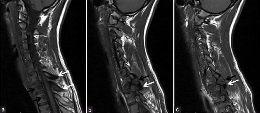 18-year-old male with a 6-month history of pain in left half of the neck, left shoulder and arm, which was more severe at the night, diagnosed with osteoid osteoma. T1- weighted spinal magnetic resonance imaging examination images sagittal plane show (a) signal decreases in T1 and T2 vertebra bodies concordant with edema (black arrows) and cortical sclerosis in C7-T1 spinous processes (white arrows) and (b and c) millimetric hypointense calcific foci within osteoid osteoma in T1 vertebra left lamina-transvers process junction (black arrows) and prominent sclerosis in the bone tissue around it (white arrows).