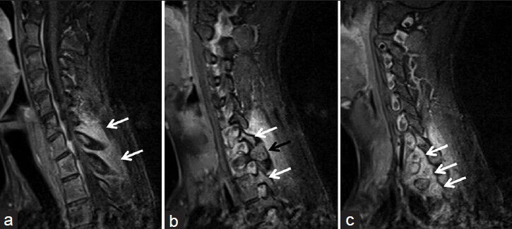 18-year-old male with a 6-month history of pain in left half of the neck, left shoulder and arm, which was more severe at the night, diagnosed with osteoid osteoma. Contrast-enhanced T1-weighted fat suppression spinal magnetic resonance imagingexamination images in sagittal plane show (a) marked contrast enhancement secondary to inflammation-edema in paravertebral soft tissues, (b) osteoid osteoma (black arrow) and enhancement in the medullar bone marrow (white arrows) in the vicinity, and c) marked contrast enhancement secondary to inflammation-edema around left brachial plexus roots (white arrows).