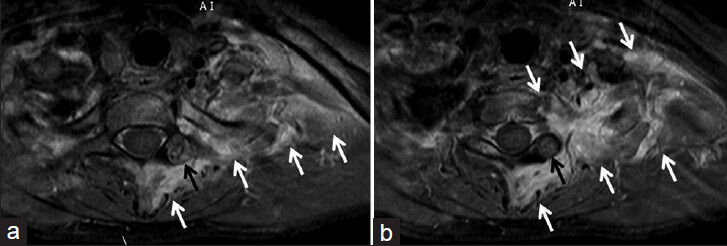 18-year-old male with a 6-month history of pain in left half of the neck, left shoulder and arm, which was more severe at the night, diagnosed with osteoid osteoma. Contrast-enhanced T1-weighted fat suppression spinal MRI examination obtained in (a and b) axial plane images show heterogeneous enhancement of osteoid osteoma (black arrows) and marked contrast enhancement (white arrows) around brachial plexus root-truncus on the left, in paravertebral soft tissues and in apex pleural surfaces of lung.