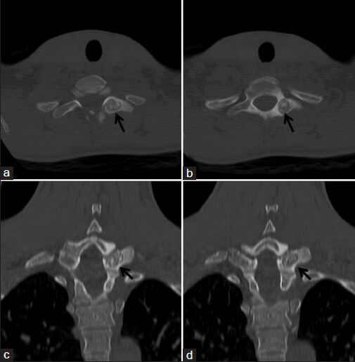 18-year-old male with a 6-month history of pain in left half of the neck, left shoulder and arm, which was more severe at the night, diagnosed with osteoid osteoma. Cervicothoracic spinal computed tomography examination after magnetic resonance imaging, (a and b) axial plane images, (c and d) coronal plane reformatted consecutive images show slightly contoured lobule, straight edged osteoid osteoma (black arrows) with calcific foci in T1 vertebra left lamina-transverse process junction.