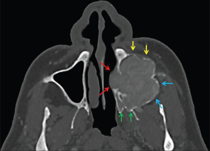 59-year-old man presented with a 10-month history of pain and swelling inthe left maxillary sinus diagnosed with Brown tumor associated with tertiary parathyroidism. (October 14, 2010) Axial maxillofacial computed tomography scan shows a lesion on the floor of the left maxillary sinus extending through the nasal cavity (red arrows), infratemporal fossa (blue arrows), pterygopalatine fossa (green arrows), and premaxillary region (yellow arrows). The expansion of the left maxillary sinus is visible.