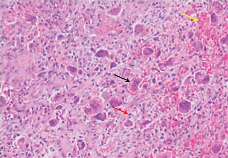 59-year-old man presented with a 10-month history of pain and swelling inthe left maxillary sinus diagnosed with Brown tumor associated with tertiary parathyroidism. Histopathologic slide shows multiple giant cells (black arrow) with spindle-shaped stromal cells, fibrous connective tissue (red arrow) proliferation, and areas of hemorrhage (yellow arrow) (H and E, × 40).