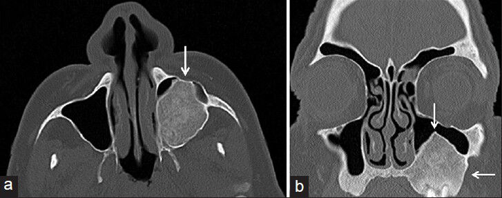 59-year-old man presented with a 10-month history of pain and swelling in the left maxillary sinus diagnosed with Brown tumor associated with tertiary parathyroidism. (January 30, 2013) 27-month post-treatment (a) axial and (b) coronal maxillofacial computed tomography images reveal thickening of bone walls of the lesion with a reduction of the tumor volume (arrow) and increase in the density of the lesion.