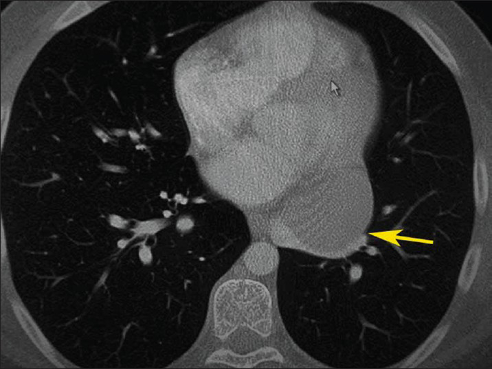18-year-old male with progressive dyspnea on exertion and dry cough diagnosed with bronchogenic cyst. Contrast-enhanced computed tomography of the chest (lung window) shows a well-defined round homogeneous low-density mass in the mediastinum adjacent to the left main bronchus measuring 5.1 cm × 5.8 cm at its maximum, causing over 80% luminal narrowing of both left pulmonary veins (yellow arrow).